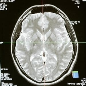 Brain Injury Image for Montoya Hinckley Injury Lawyers Located in Whashington