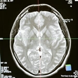 What Is the Average Settlement for a Brain Injury?
